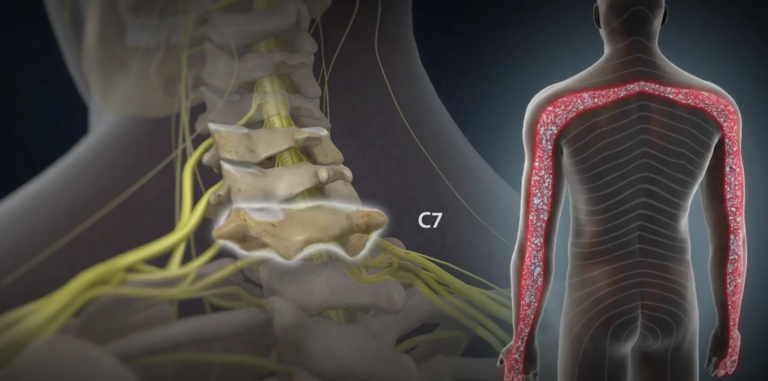 Cervical Radiculopathy 2 Cervical Radiculopathy C7
