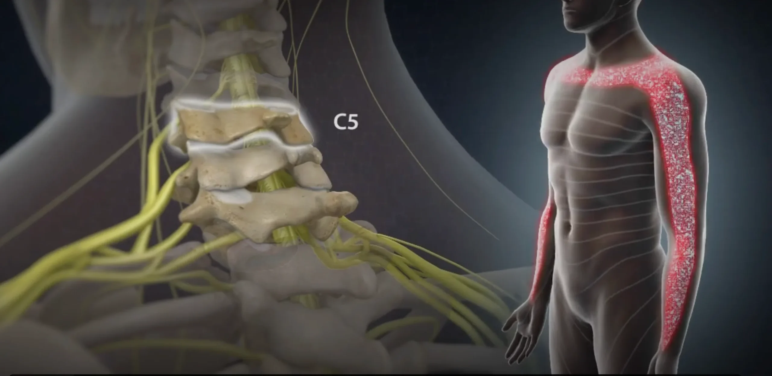 Cervical Radiculopathy 3 Cervical Radiculopathy c5