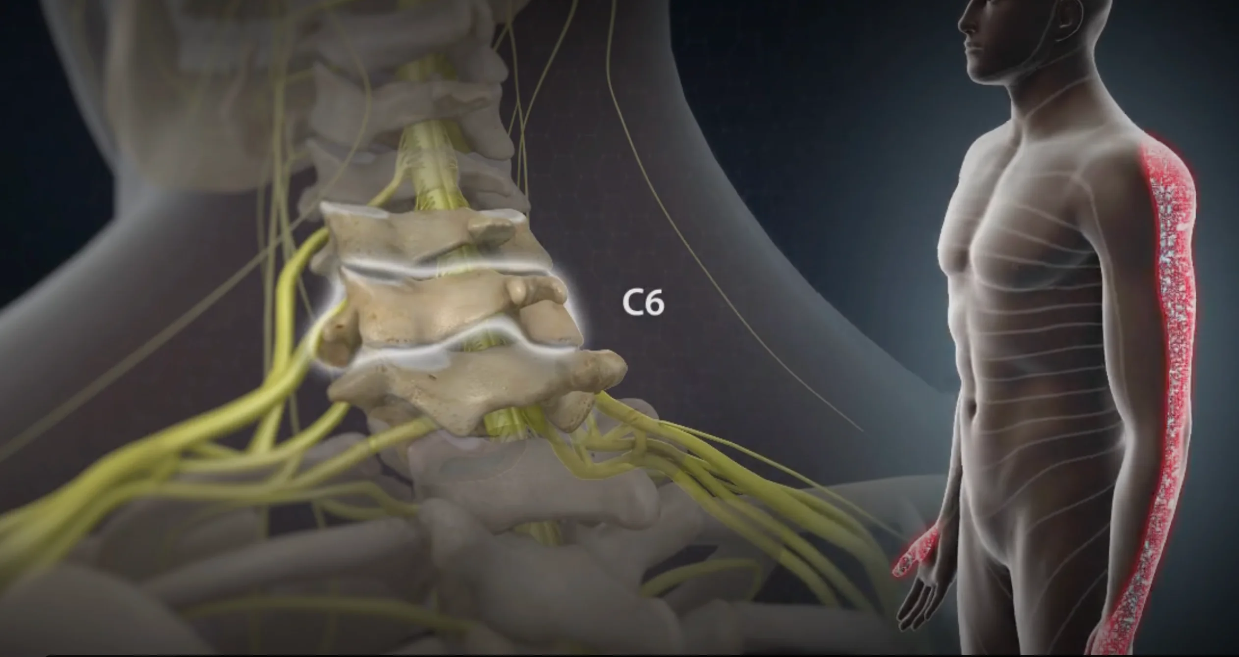 Cervical Radiculopathy 1 Cervical Radiculopathy C6